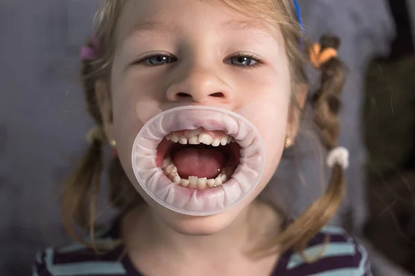 Dentes Permanentes Adultos Que Vêm Frente Dos Dentes Leite Criança — Fotografia de Stock