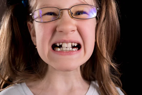 Little girl shows crooked teeth on a black background. Studio photo.