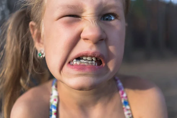 Niña Con Aparato Ortodoncia Dientes Torcidos Diente Tambaleante —  Fotos de Stock