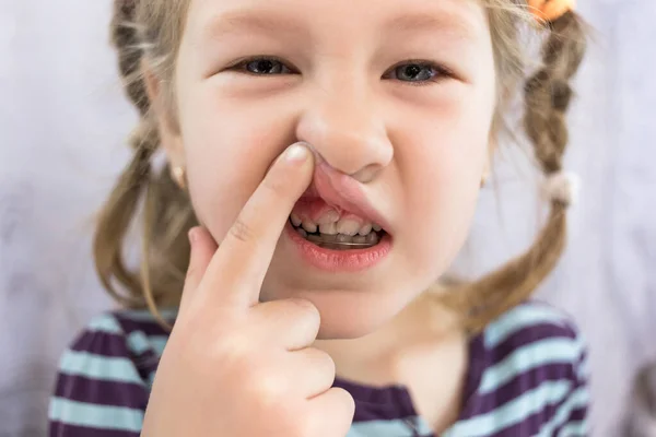 Dientes Permanentes Para Adultos Delante Los Dientes Leche Del Niño —  Fotos de Stock