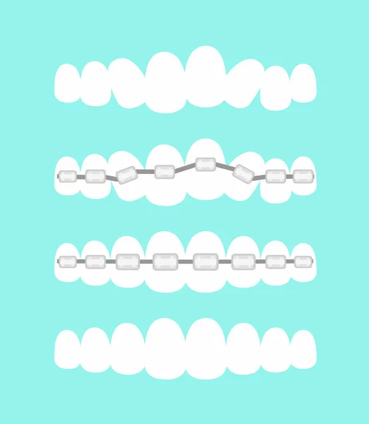 Vektor Illustration Satz von Zähnen, zahnärztliche Kieferorthopädie Behandlung mit Zahnspangen, Prozess der ebenen Zähne, schönes Lächeln im Cartoon flachen Stil. — Stockvektor