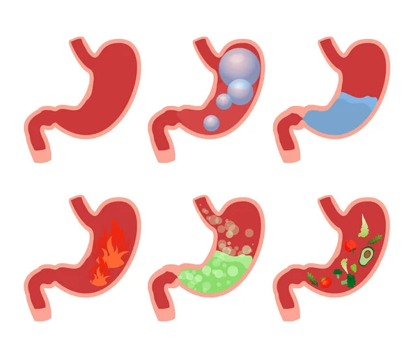 Desenho animado ilustração vetorial conjunto ilustrações médicas do abdômen inchado estômago. Diferentes tipos de doenças estomacais. Gás, álcool, inchaço, azia, comida e água no interior do estômago . —  Vetores de Stock