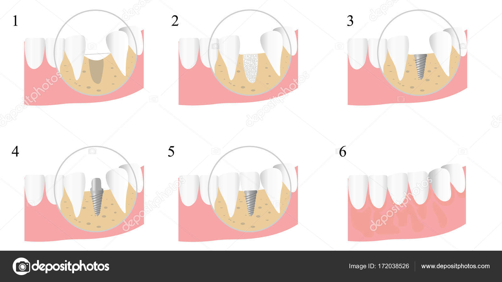 Остеопластика челюсти. Синус-лифтинг (костная пластика, остеопластика) закрытый. Синус лифтинг это наращивание костной ткани. Остеопластика челюсти. Костный материал в стоматологии.