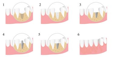 stages of implantation of teeth clipart