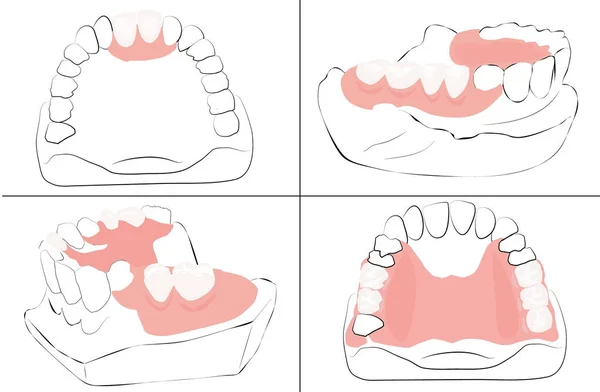 Чотири варіанти часткового зубного ряду — стоковий вектор