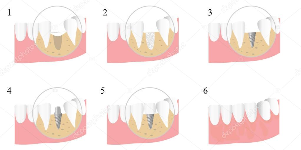stages of implantation of teeth
