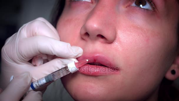 Labios de mujer de primer plano 4K con relleno de ácido hialurónico — Vídeo de stock