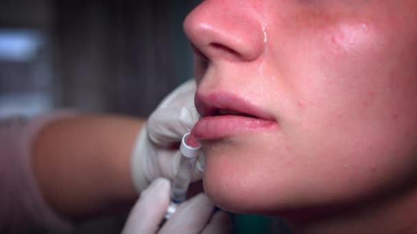 4 k vrouw gezicht met injectie Lip vuller — Stockvideo