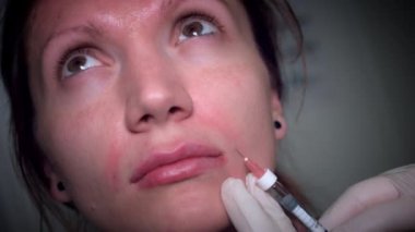 4 k doktor uygulanıyor nazolabial dolgu