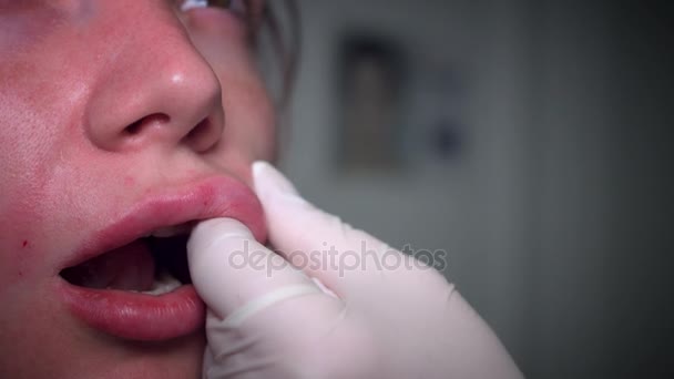 4k Close-up van neus-liplijnen vuller Procedure — Stockvideo