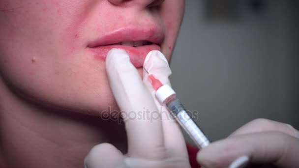 4 k Close-up vrouw lippen met hyaluronzuur Filler — Stockvideo