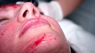 4 k yakın çekim kadın yüz kanama, Microneedling yordam