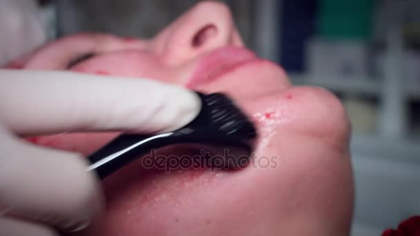 4K Doctor haciendo procedimiento de microneedling — Vídeo de stock