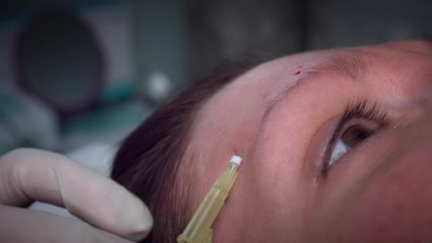 4K Doctor Applying PDO Thread Lifts in Woman Forehead — Stock Video