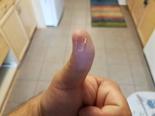 Peeling della pelle su pollice su mano maschile in cucina — Foto Stock