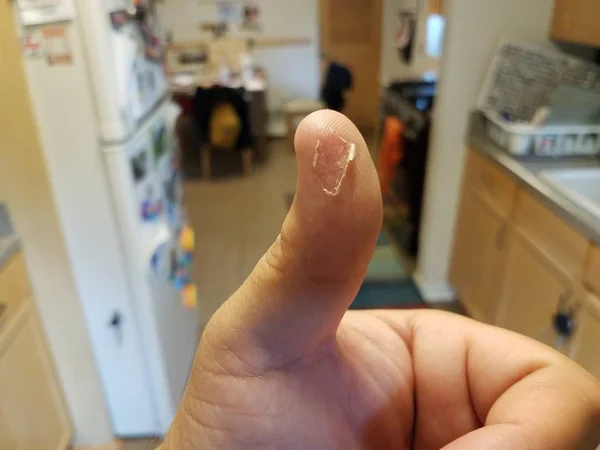 Olupování kůže na palci na mužské ruce v kuchyni — Stock fotografie