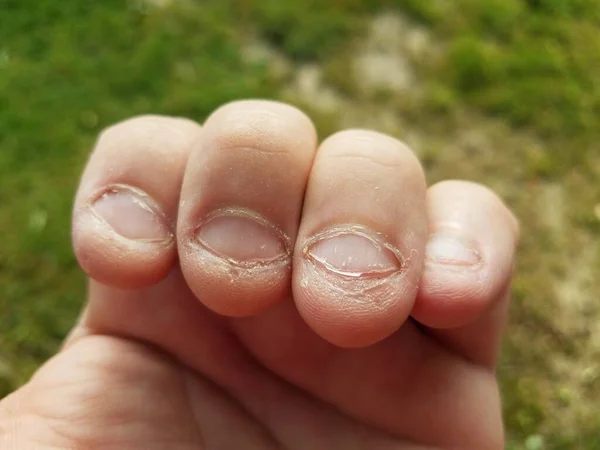 Mordido Desagradável Nojento Grosso Mastigado Curto Unhas Mau Hábito — Fotografia de Stock