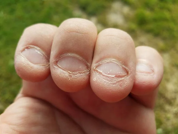Damaged Nervous Nails, Biting Nails on Fingers Stock Photo - Image of  finger, hand: 134997178