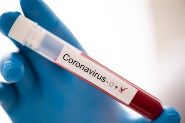 Elinde kan örneği olan bir test tüpünün yakın çekimi. Lastik eldiven. Coronavirüs teşhisi Covid-19.
