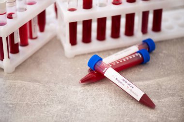 COVID-19 testi için kan örneğiyle test tüpü, yeni Coronavirus 2019. Aşı kavramı, Covid-19 koronavirüs teşhisi, grip virüsünün tedavisi..