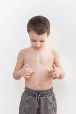 Suçiçeği hastası küçük üzgün çocuk, sivilcelerini vücudunda gösteriyor.