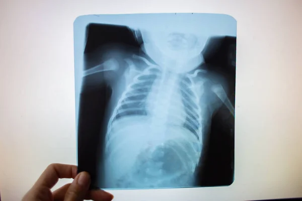 Röntgenkép egy kisgyermek hasi szerveiről a lumenben egy fehér képernyőn. Orvosi eszközök — Stock Fotó