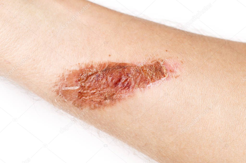 dried wound on the skin of the hand on a white background