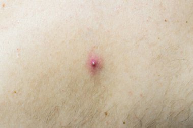 Açık tenli bir adamın derisindeki sivilce. Açık tenli bir adamın derisindeki sivilce..