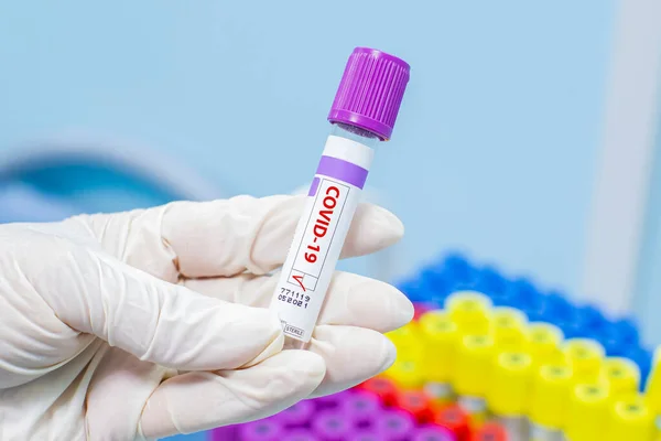 Coronavirus Covid Caso Positivo Tubo Exame Sangue Close Laboratório Médico — Fotografia de Stock