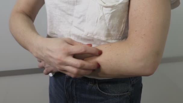 Mulher Alergia Arranhando Braços Mãos Com Dedos — Vídeo de Stock