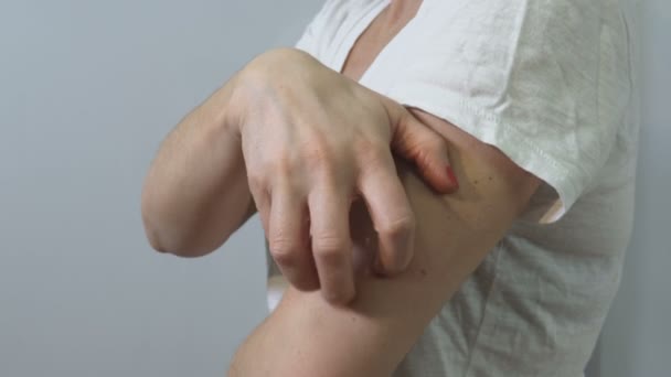 Gezondheidsprobleem Huidziekten Vrouw Krabben Haar Jeukende Arm — Stockvideo