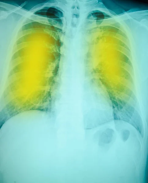 Röntgenuntersuchung der Brust zur Diagnose — Stockfoto