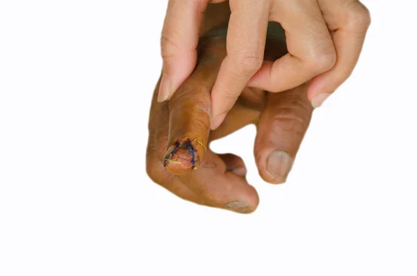 Травма Пальця Перев Язувальна Рана Білому Тлі — стокове фото