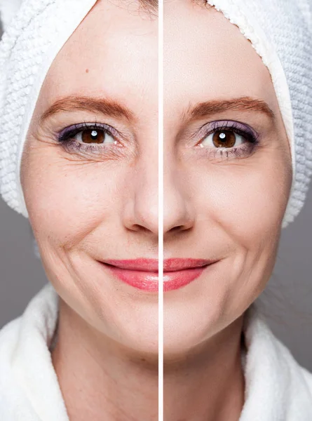 Mulher feliz após o tratamento de beleza - antes / depois de tiros - pele c — Fotografia de Stock