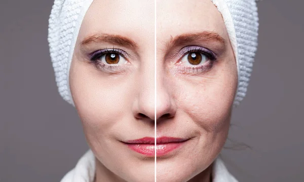 Счастливая женщина после косметических процедур - до / после уколов - кожа c — стоковое фото