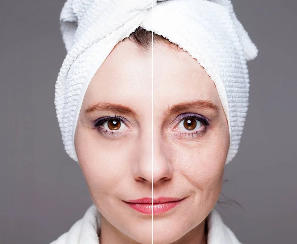 Mujer feliz después del tratamiento de belleza - antes / después de las inyecciones - piel c —  Fotos de Stock