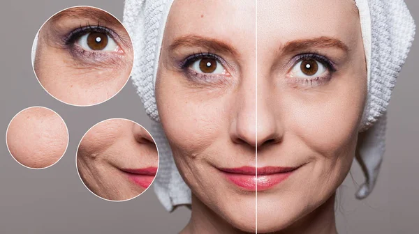 Happy woman after beauty treatment - before/after shots - skin c — Stock Photo, Image