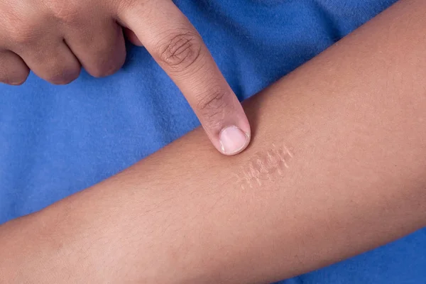 A scars at hand — Stock Photo, Image