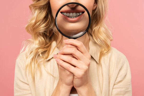 Cropped view of woman with dental braces holding magnifying glass isolated on pink