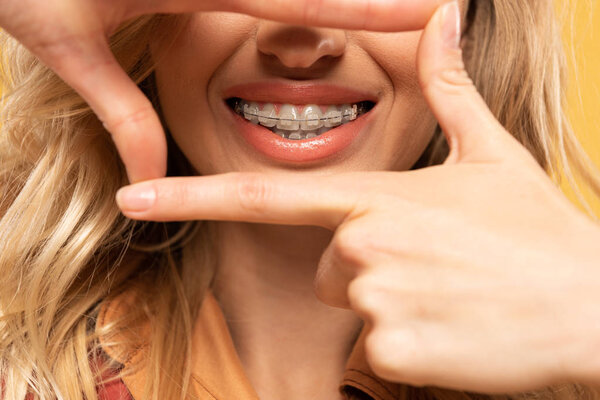 Cropped view of smiling woman with dental braces isolated on yellow