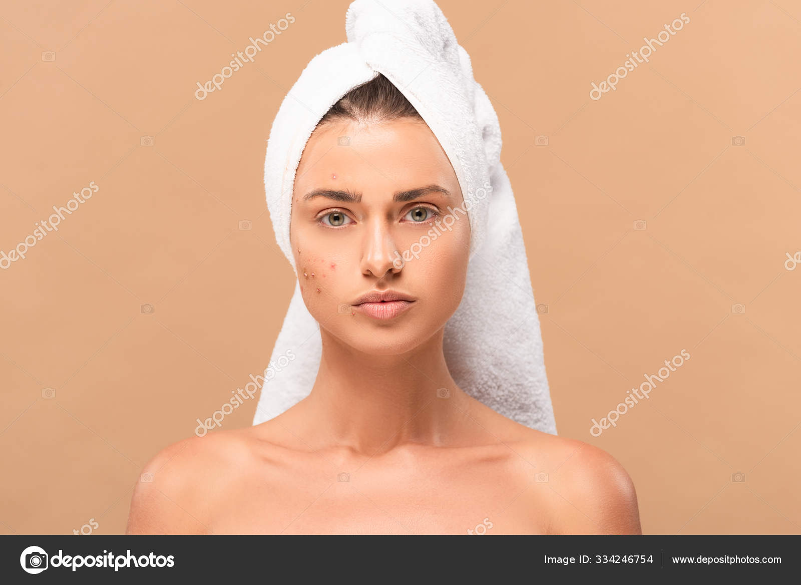 Nude Girl Towel Acne Face Isolated Beige Stock Photo Igorvetushko