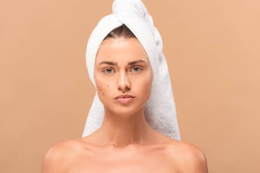 nude girl in towel with acne on face isolated on beige  clipart