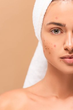 Yüzünde sivilce olan havlulu çıplak bir kız bej rengi izole edilmiş. 