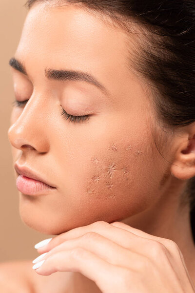 young woman with closed eyes and acne on face isolated on beige 