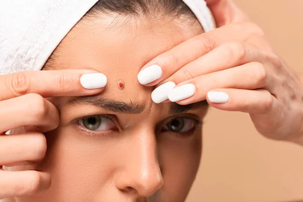 Cropped View Young Woman Towel Squeezing Pimple Isolated Beige — Stock Photo, Image