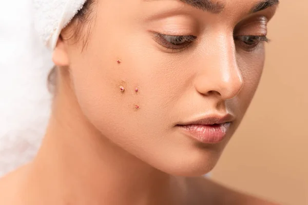 Close Young Woman Pimples Face Isolated Beige — Stock Photo, Image