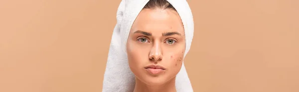 Panoramic Shot Woman Towel Acne Face Isolated Beige — Stock Photo, Image