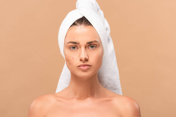 nude girl in towel with acne on face isolated on beige 
