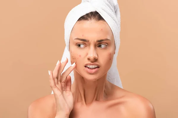 Upset Nude Girl Towel Touching Acne Face Isolated Beige — Stock Photo, Image