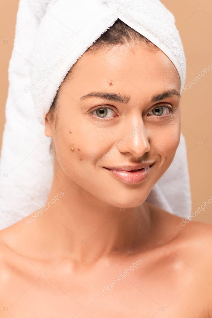 happy naked girl with pimples on face looking at camera isolated on beige 